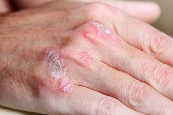 hand psoriasis symptoms