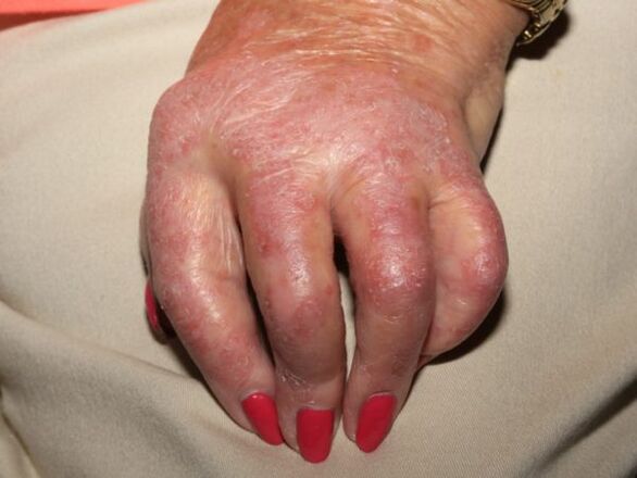 manifestations of psoriasis in the hands