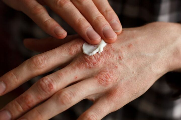 psoriasis treatment in the hands of a child