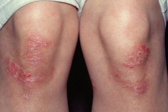 psoriasis in the knees