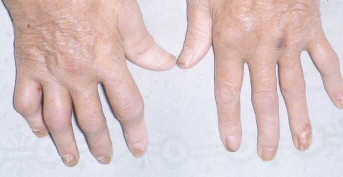 arthropathic psoriasis in the hands