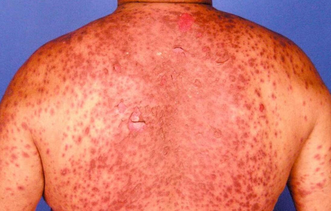 psoriatic erythroderma in the back