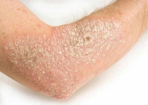 psoriasis vulgaris in the elbow