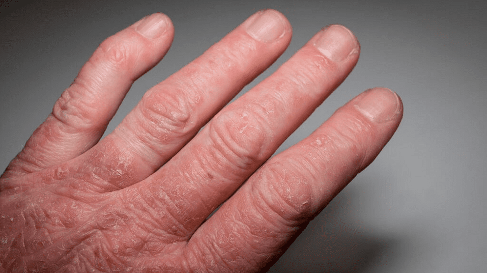 psoriatic arthritis in hands