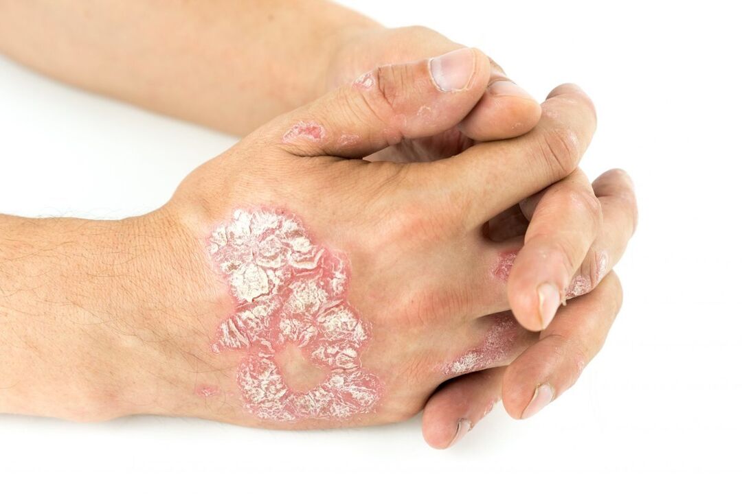 how is the psoriasis in the hands