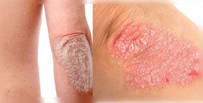 how is psoriasis on the skin