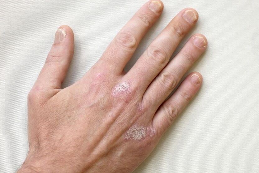 An obligatory symptom of psoriasis are scaly plaques on the skin