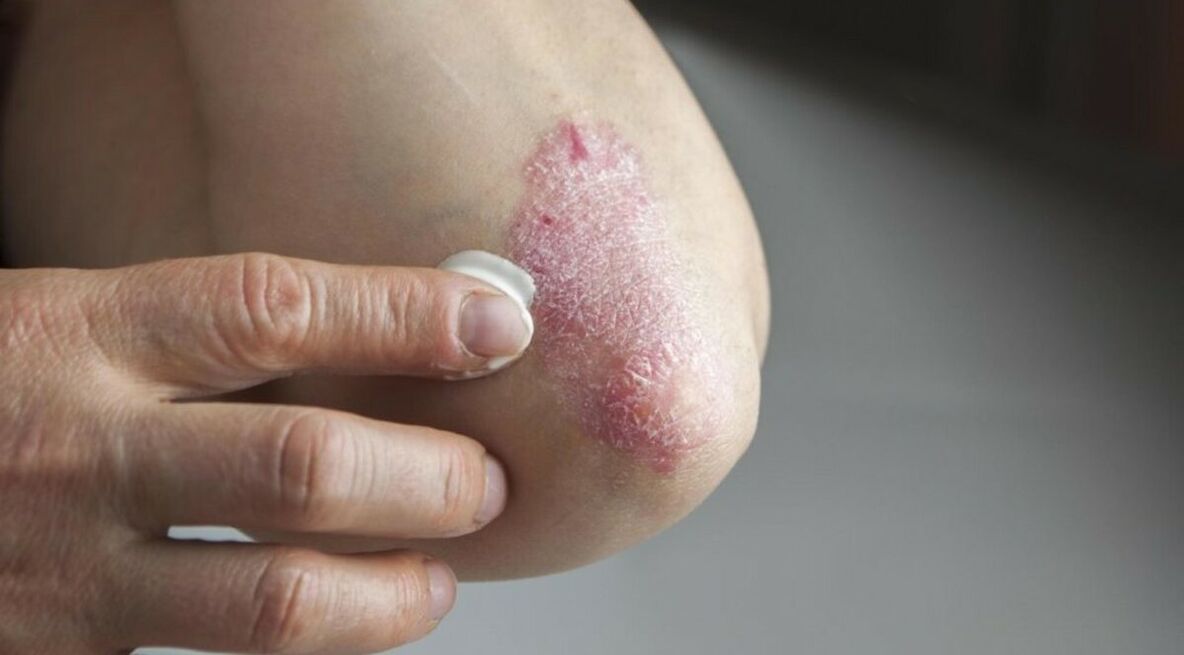 Psoriasis that affects the skin, the treatment of which includes the use of ointments