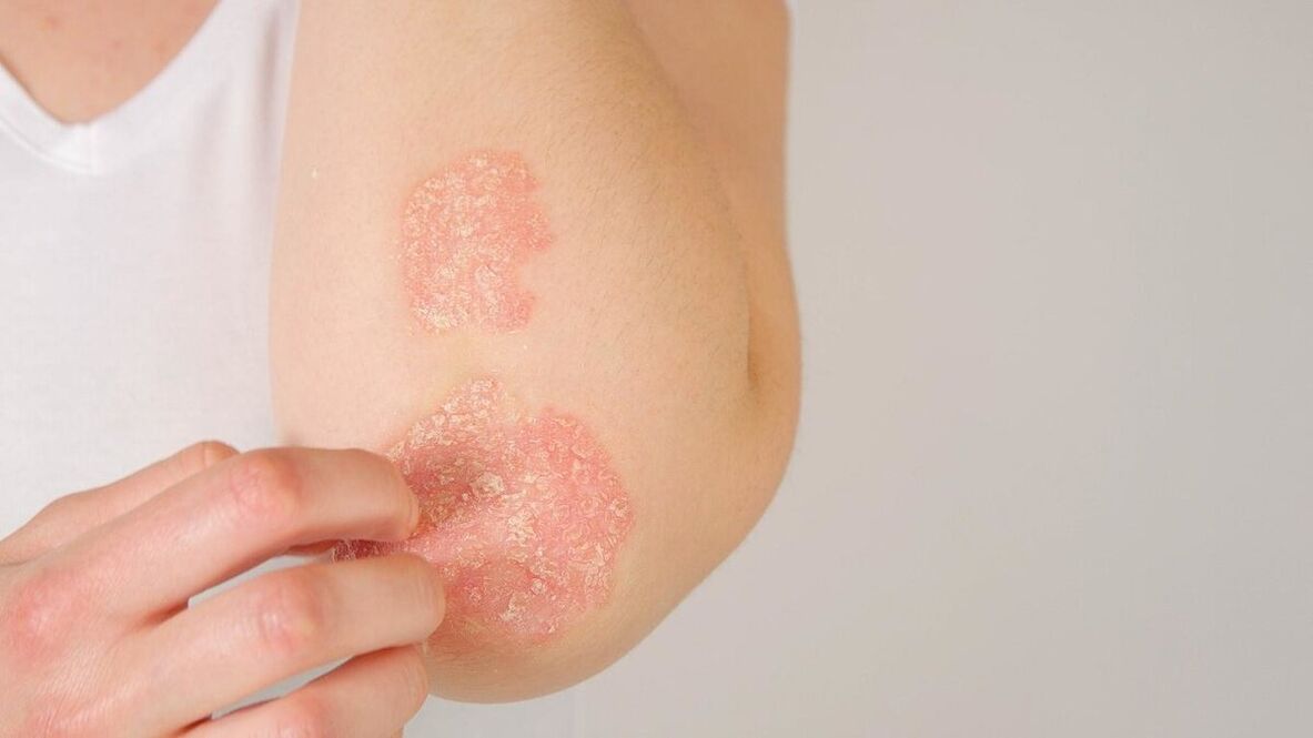 Psoriatic plaques on the elbows