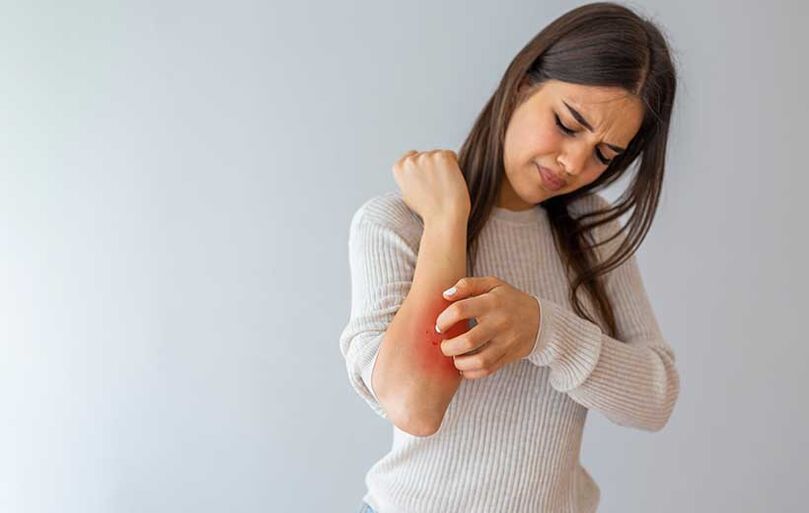 Psoriasis manifests as rashes and itching
