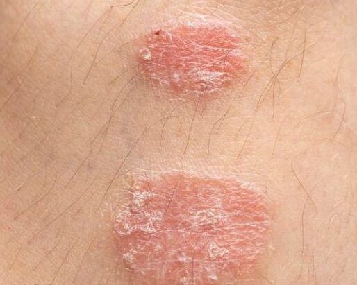 Appearance of psoriatic plates