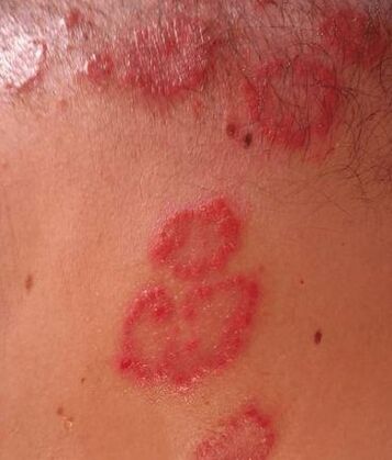 Psoriasis points