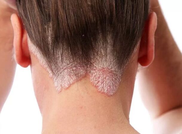 Psoriatic erythroderma