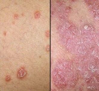 Psoriatic plates