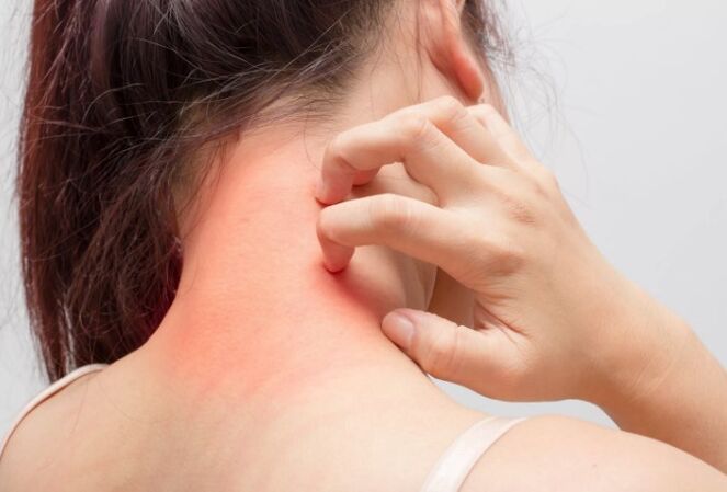 The itching is one of the causes of psoriasis