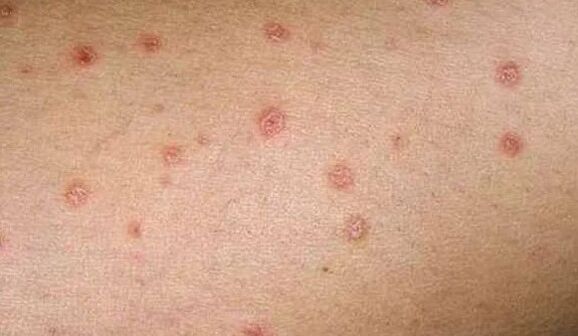The early stage of psoriasis