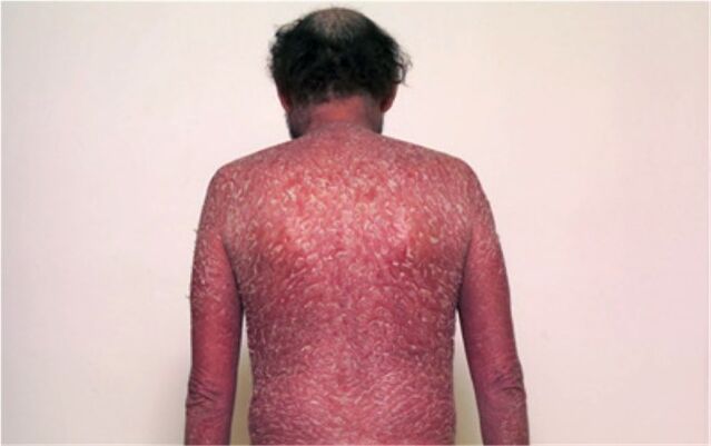 The third step of psoriasis