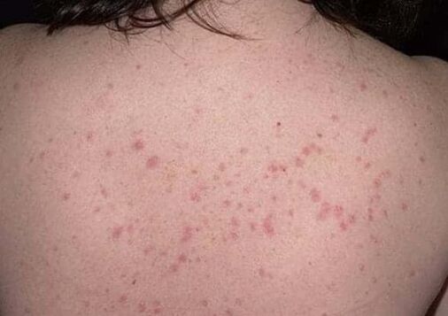 The early stage of psoriasis