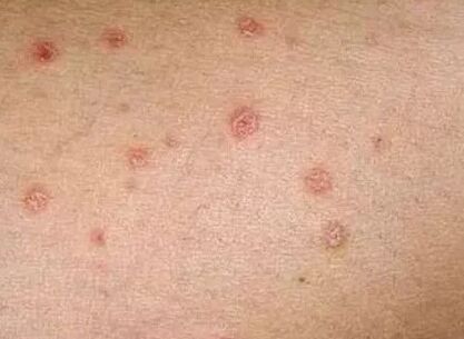 Early Stage Psoriasis