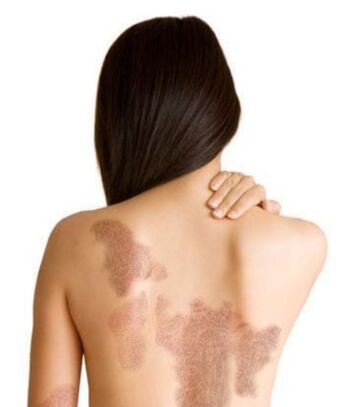 Stages of psoriasis, depending on the area of ​​the lesion