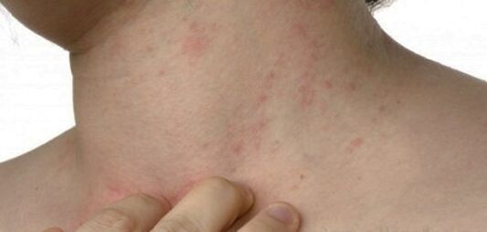 Neck psoriasis