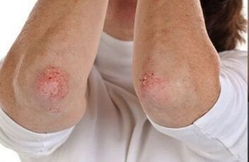 Psoriasis in the elbows