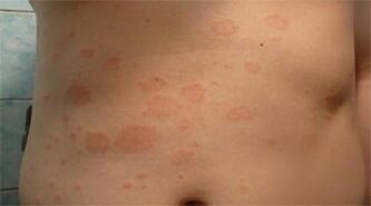 Stomach psoriasis