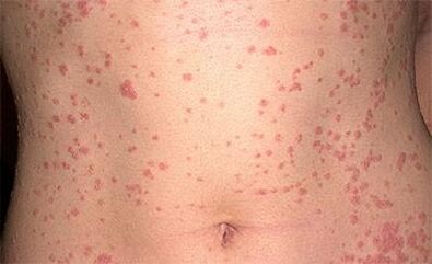Psoriasis in the body