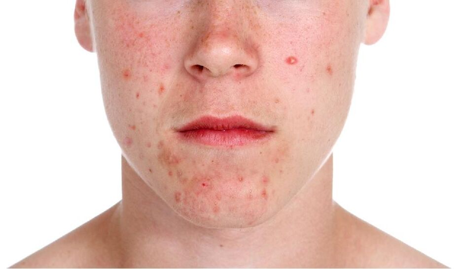 Psoriasis on the face