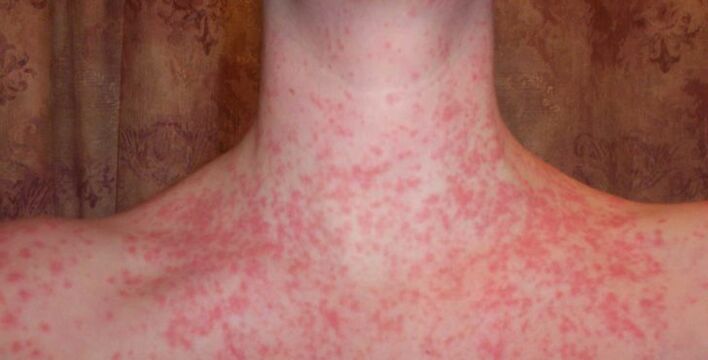 Psoriasis in the body