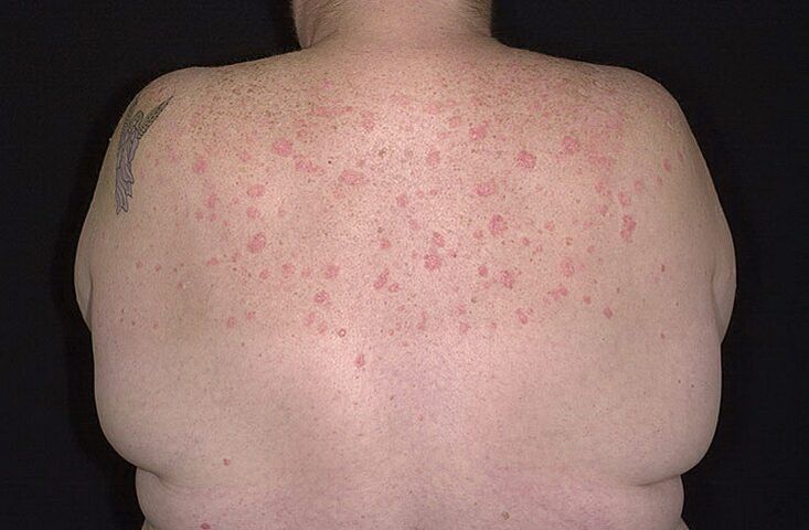 Shoulder psoriasis