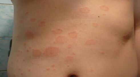 Early Stage Psoriasis