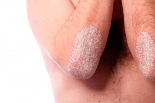 Psoriasis on elbows
