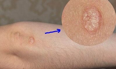 psoriasis development stages