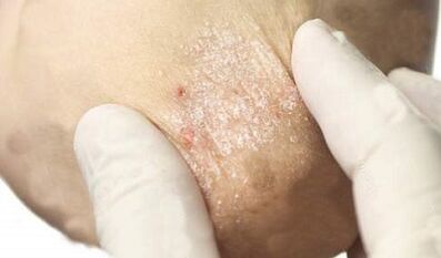 psoriasis treatment in the attenuation phase