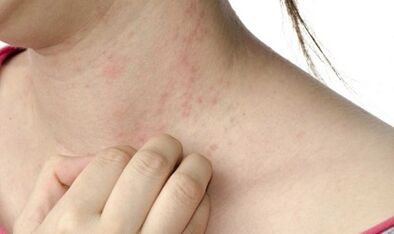 treatment of advanced stage psoriasis