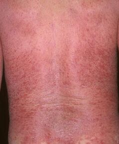 Erythroderma