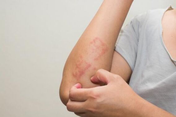The latest methods of psoriasis treatment