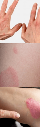 Early stage psoriasis in the hands
