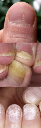 Psoriasis Nail - Early Stage