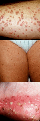 Psoriasis in the legs