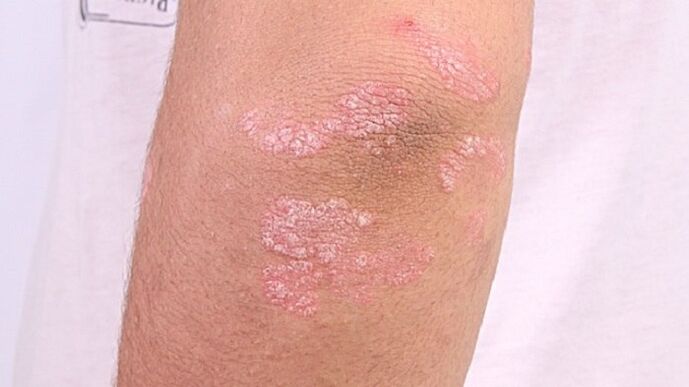 early stage psoriasis photo