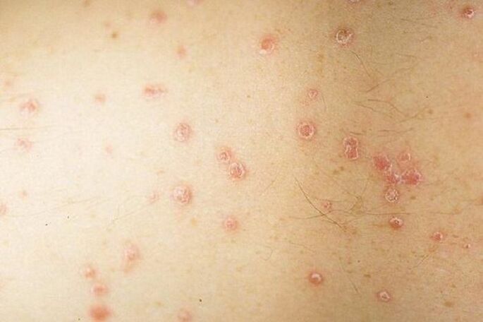 localized psoriasis symptoms