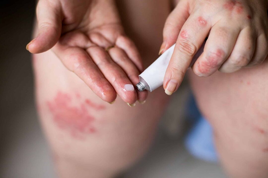 Psoriasis treatment