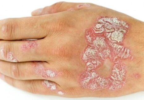 psoriasis on hand