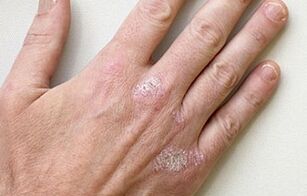 symptoms of early psoriasis