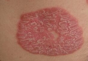 psoriasis skin pictures