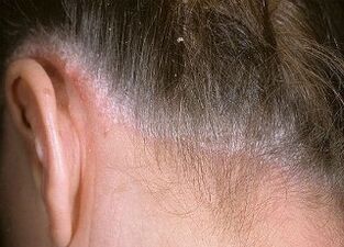 causes of psoriasis in the head