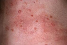 psoriasis skin photo