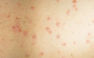 photo of the early stage of psoriasis